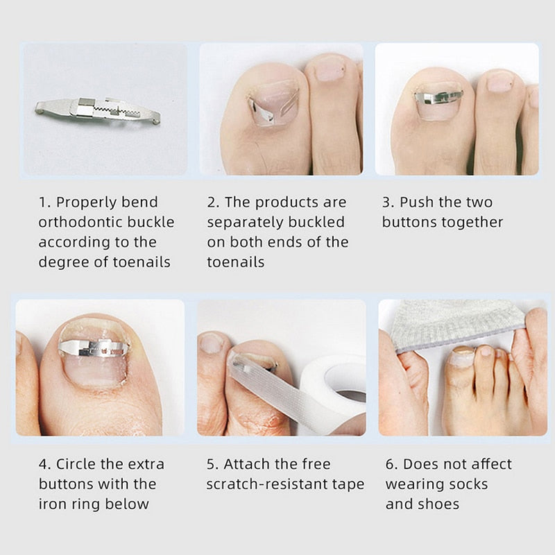 SK321-Ingrown Toenail Corrector Tools